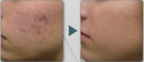 (Example) Before and after Aquatouch use – Acne treatment