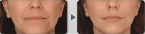 (Example) Before and after Aquatouch use – Botox improvement treatment