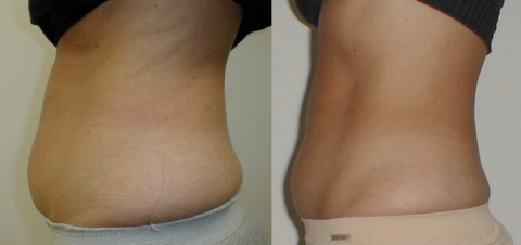 (Example) Coolipo Twin before used treatment (left) after 9 times of Treatment (right)