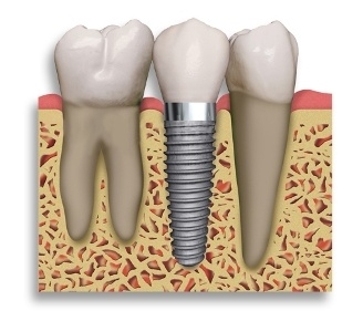 원데이 임플란트는 잇몸뼈가 양호하고, 어떠한 강도에도 흔들리지 않고 버틸 수 있는 힘이 있는 경우 식립 가능하다.