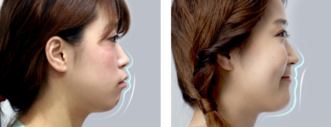 양악수술이 아닌 치아교정을 통한 돌출입 교정 사례