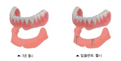 임플란트 틀니는 기존 틀니에 비해 고정력이 강하고, 불편함이 적다.
