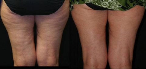 (Example) Before (left) and after (right) the cellulite treatment using Decell