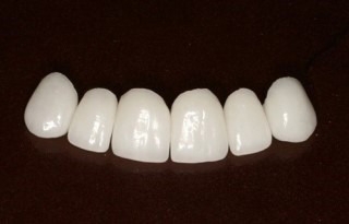 무삭제 라미네이트는 치아 삭제 없이 앞니를 개선해준다.