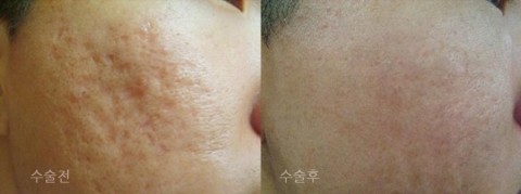 여드름으로 함몰된 흉터는 해당 부위 진피층에 이산화탄소가스와 히알루론산을 순차적으로 주입하여 새로운 콜라겐 조직을 자생적으로 만들면 쉽게 치료할 수 있다.