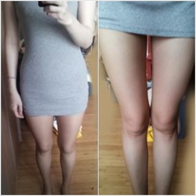 특허받은 MPL시술을 하면 운동여부와 시기, 적절한 식단 등 살을 건강하고 탄력있게 빼기 위한 스케줄을 안내받게 된다.