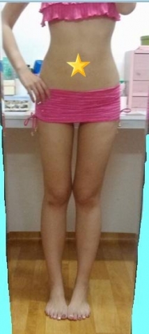 한 여성이 MPL주사 시술 후 사진을 촬영하고 있다.