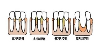 잇몸병으로 치아가 발치된 경우 임플란트 치료가 이어진다. 염증으로 잇몸뼈가 수축될 경우 뼈이식 치료도 동반될 가능성이 높다.