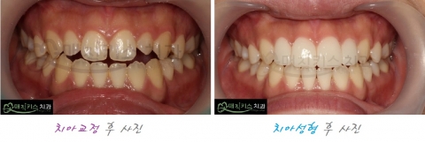 같은 환자에서 치아교정과 치아성형 사례 비교사진