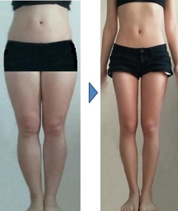 MPL주사 시술 후의 모습