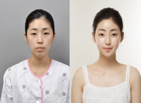 김소영 씨가 신데렐라성형외과에서 성형수술 후 연예인같은 변신으로 화제를 모으고 있다.