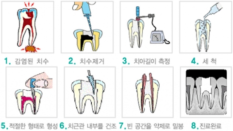 신경치료는 이전에 말기 충치로 빼야 했던 많은 수의 치아를 살려내는 치료법이다.
