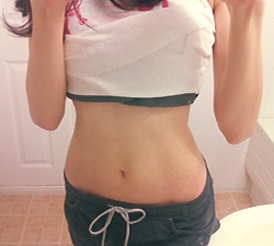 MPL주사 시술 후 모습