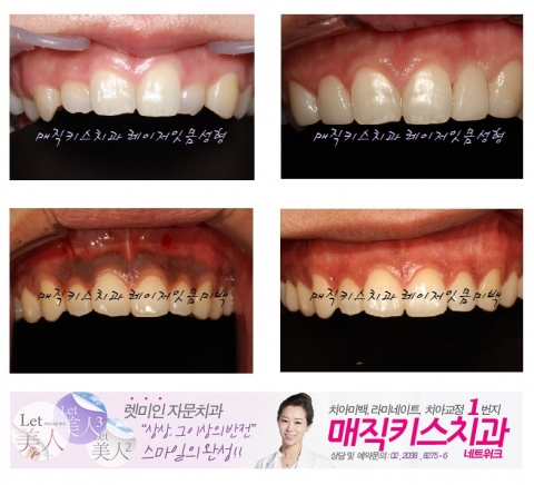 레이저 잇몸성형 및 잇몸미백 전후사진