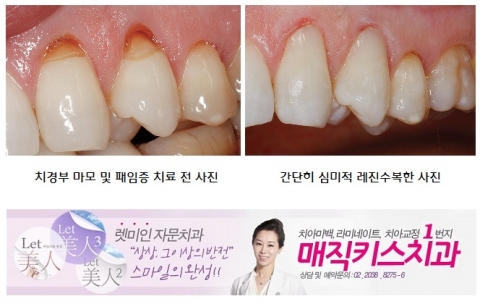 치경부 마모증을 레진을 이용한 심미적으로 치료한 전후사진