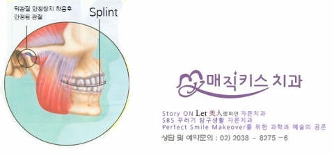 매직키스치과가 교합안정장치를 소개했다.