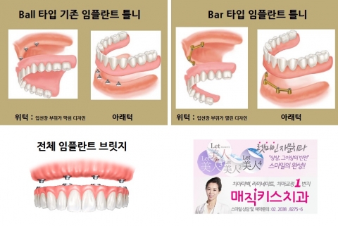전체임플란트, 임플란트 틀니술식 모식도