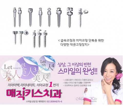 미니스크류 및 여러가지 악골고정장치가 급속교정에 사용되고 있다.