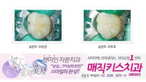 만 18세까지 보험급여가 적용되는 실란트 모식도