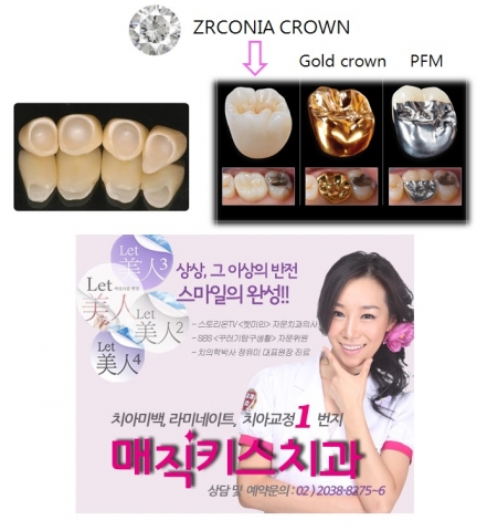 매직키스치과에서는 라미네이트를 비롯한, 치아성형술을 파격적인 비용으로 시술하는 이벤트를 단행 중이다.