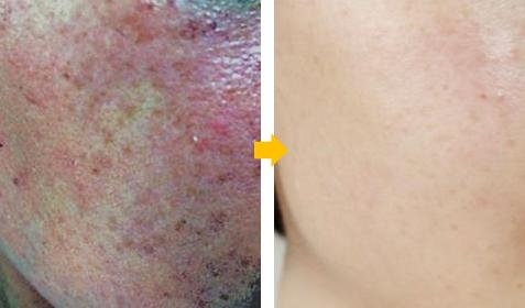 자외선에 의해 생기거나 그 증상이 더 악화되기 쉬운 기미 피부인 경우 봄이 두렵기 마련이다.