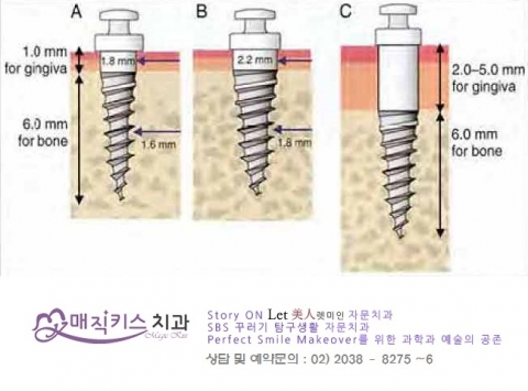 뼈의 두께에 따른 부위별 미니스크류의 선택법