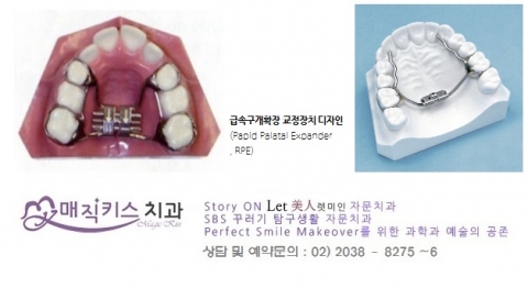 성인도 위턱 부착형 급속구개확장 교정장치를 이용할 수 있다.