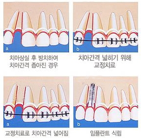 치아상실 후 방치할 경우 치아 사이가 벌어지고, 턱 관절 장애, 소화기 질환 발생, 충치, 잇몸질환 등 다양한 질환이 발생 할 수 있다.