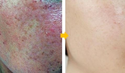 휴먼피부과의 경우 피부과 전문의들로 구성되어 있으며, 기미, 잡티 등 색소질환을 위한 얼색없애기 프로그램을 시행중이다.