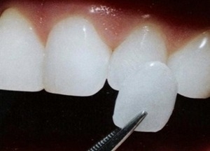 무삭제 라미네이트는 치아를 삭제하지 않거나 0.2mm 정도로 아주 미세하게 삭제하는 방식이다.
