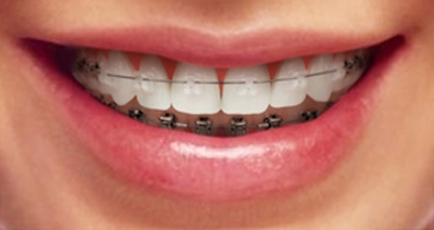치아교정은 비뚠 치열을 가지런하게 정돈하며 그로 인해 발생할 수 있는 충치와 잇몸질환을 예방하며 구강건강을 보호한다. 치아가 반듯해지며 미용적인 측면까지 고려하여 환한 미소와 아름다운 입매라인을 완성시킨다.