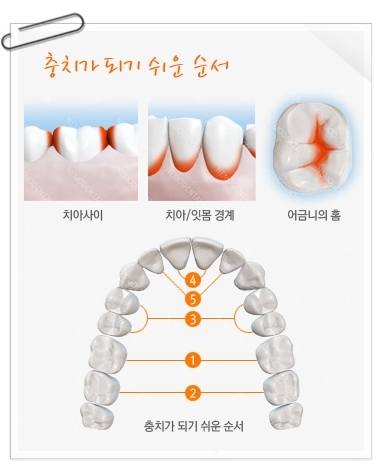 충치는 치아 사이, 치아와 잇몸 사이, 치아 안쪽, 어금니 윗면 등 양치질이 잘 안 되는 부위에 잘 발생한다.