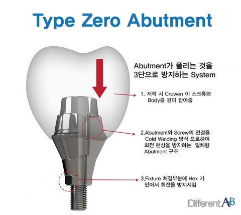 풀리지 않는 임플란트 어버트먼트