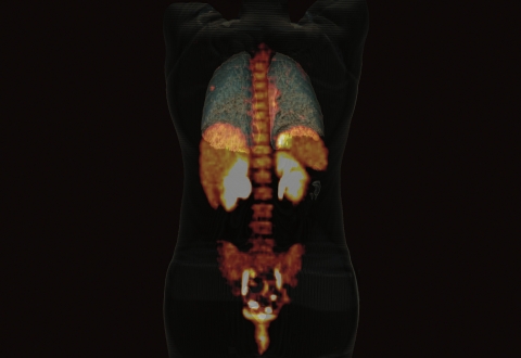 새롭게 출시된 바이오그래프 호라이즌(Biograph Horizon™) PET·CT 시스템