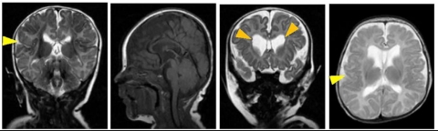 SON 변형으로 발현이 감소됨이 발견된 환자의 뇌 MRI. 대뇌피질의 비정상적 형성, 뇌실확장, 좌뇌와 우뇌를 연결하는 뇌량의 감소등이 나타남