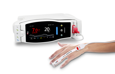 Study Finds Noninvasive, Continuous Masimo PVi® Monitoring More Valuable Than Central Venous Pressur...