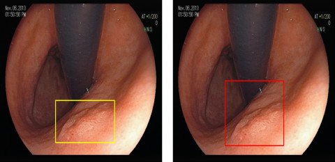 위내시경의 병변도의 경중을 색깔별로 표시해 실시간으로 인공지능 병변 추적을 하고 있다