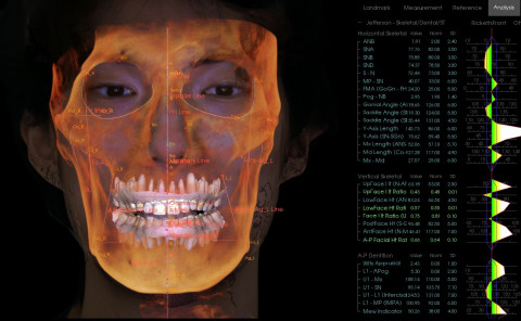 Invivo Model을 이용하면 기존 Cephalometry에서는 볼 수 없었던 환자의 3D 해부학 랜드마크들을 안면 스캔 파일, CBCT 기반의 구강 모델과 결합해 정밀한 진단