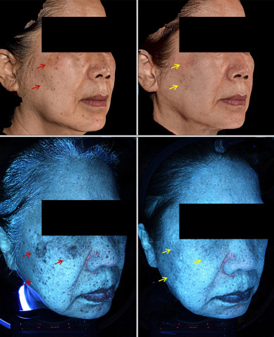 레이저옵텍의 ‘헬리오스785’를 활용한 SCI급 연구 논문 ‘DOE 프락셔널 785nm 피코레이저와 ICG 국소 도포를 이용한 아시아 여성의 스킨 리쥬비네이션 효과’의 임상 사진(