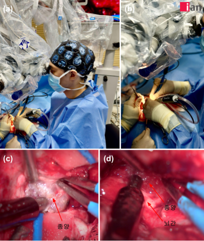(a), (b) 이안동물신경센터 김우경 팀장이 현미경을 통한 미세 뇌수술을 집도하는 모습. (c) 경피질 접근법(Transcortical approach)을 통한 뇌종양으로의 접근