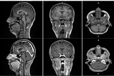 First-in-human contrast enhanced MRI images with GE HealthCare’s mangaciclanol