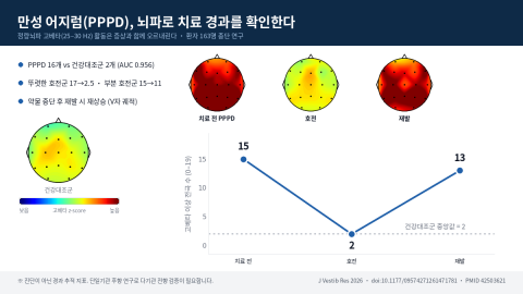 만성 어지럼(PPPD) 환자의 정량뇌파 고베타(25~30㎐) 활동은 치료로 호전되면 건강대조군 수준까지 낮아지고, 약을 중단해 재발하면 다시 올라간다(제공=천안삼성스마트신경과의원)
