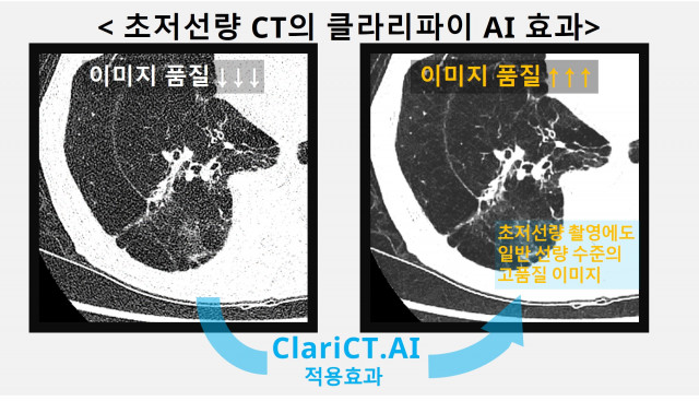 초저선량 흉부 CT의 ClariCT.AI 적용 전후 비교