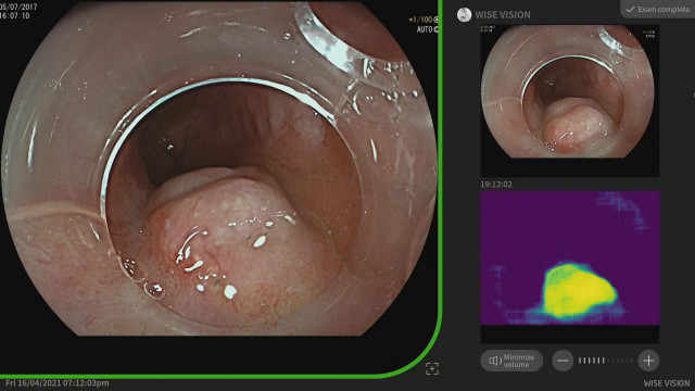NEC’s AI Supports Doctors to Detect Neoplasia in Barrett’s Esophagus During Endoscopic Procedures