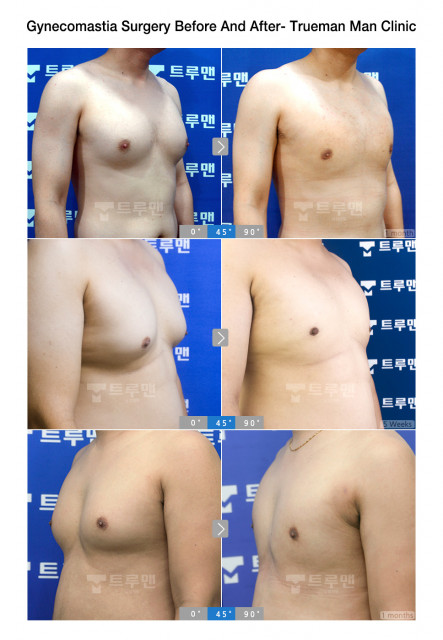 Trueman Man Clinic Network Demonstrates Its Excellence in Gynecomastia Surgery in Korea with 25,700 ...