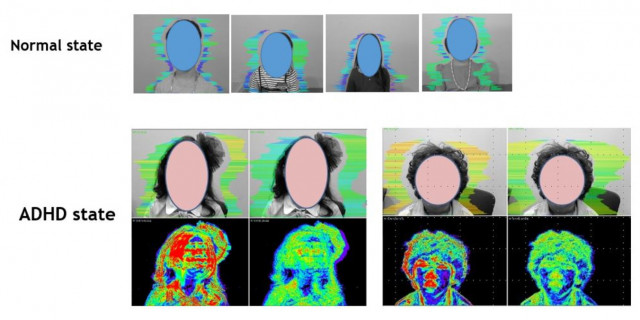 바이브라 이미지 기슬을 활용한 정상인 상태와 ADHD 환자 측정 비교 사진