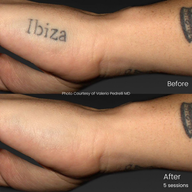 Pico Tune-Ink Treatment - tattoo removal (Photo: Business Wire)