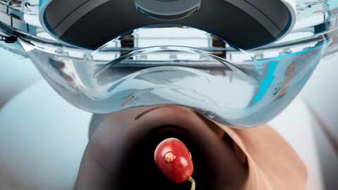 Edison Histotripsy System Procedure for Kidney Tumor Animation