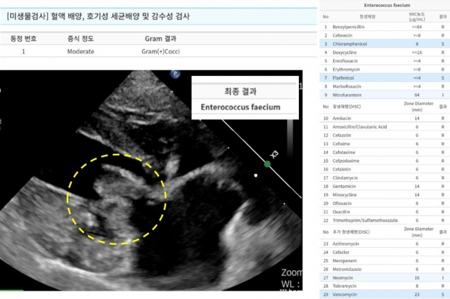 노란색 원 안에 빠른 속도로 심각하게 변성된 승모판막과 증식한 베지테이션을 확인. 혈액 배양과 심장초음파를 통해 감염성 심내막염을 확진했다