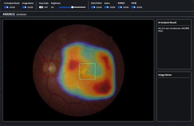 AI로 분석된 안저 영상